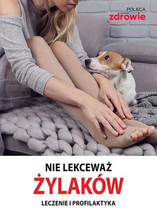 Nie lekceważ żylaków