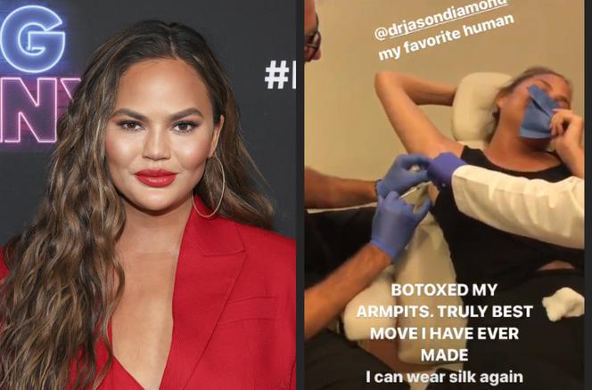 Chrissy Teigen - botoks pach