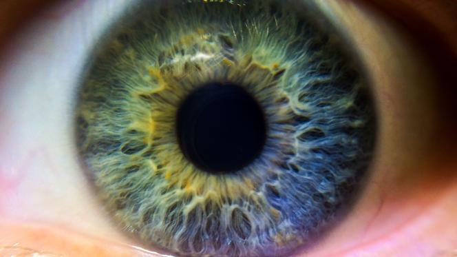 heterochomia