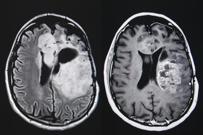 Rdzeniak zarodkowy (płodowy, medulloblastoma) - objawy, leczenie, rokowania