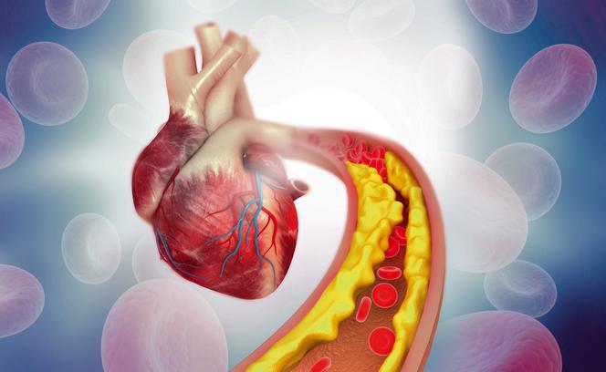 złogi cholesterolu w naczyniach