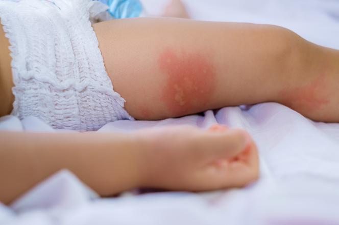 Alergia skórna - jak objawia się alergia skórna u dziecka i jak się ją leczy?
