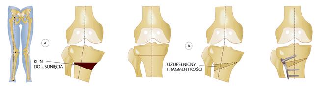 osteotomia kolana
