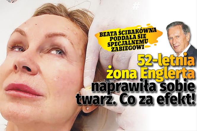 52-letnia żona Englerta naprawiła sobie twarz. Co za efekt!