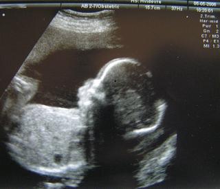 Choroby genetyczne. Czy aborcja jest możliwa w przypadku choroby genetycznej