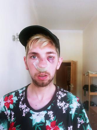 Brutalne pobicie nad jeziorem w Poznaniu! Zaatakowali ze względu na kolor włosów?! Ty ped***