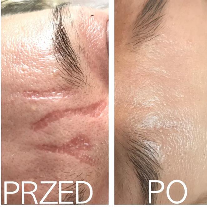 Pozbądź się blizn i rozstępów raz na zawsze! Pomogą Ci w tym specjaliści z Laser de Lux