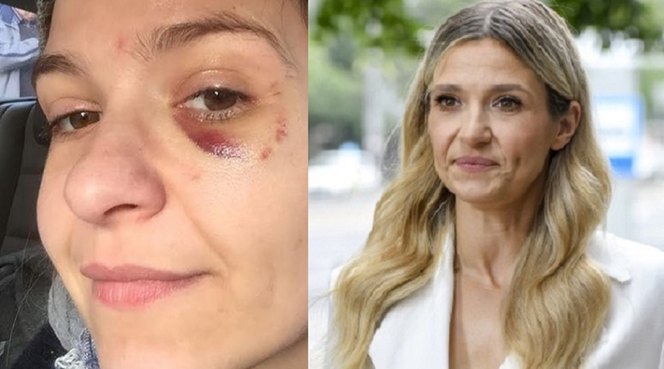 Joanna Koroniewska z siniakiem pod okiem