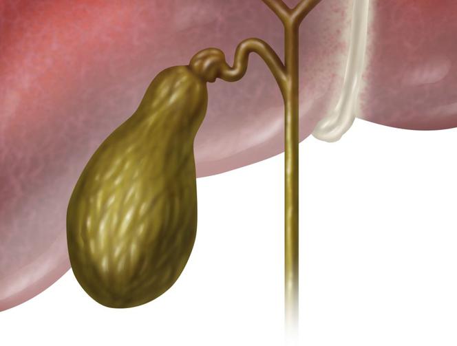 Rak pęcherzyka żółciowego: przyczyny, objawy, leczenie i rokowania