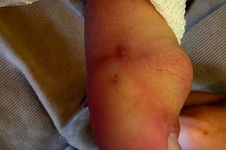 Turysta ukąszony przez żmiję.