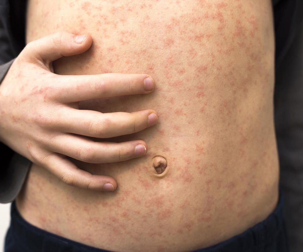 Nasi sąsiedzi szykują się na epidemię odry. Czy mamy się czego bać?