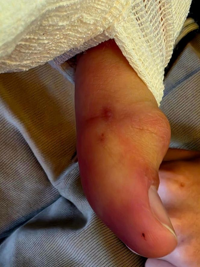 Turysta ukąszony przez żmiję.