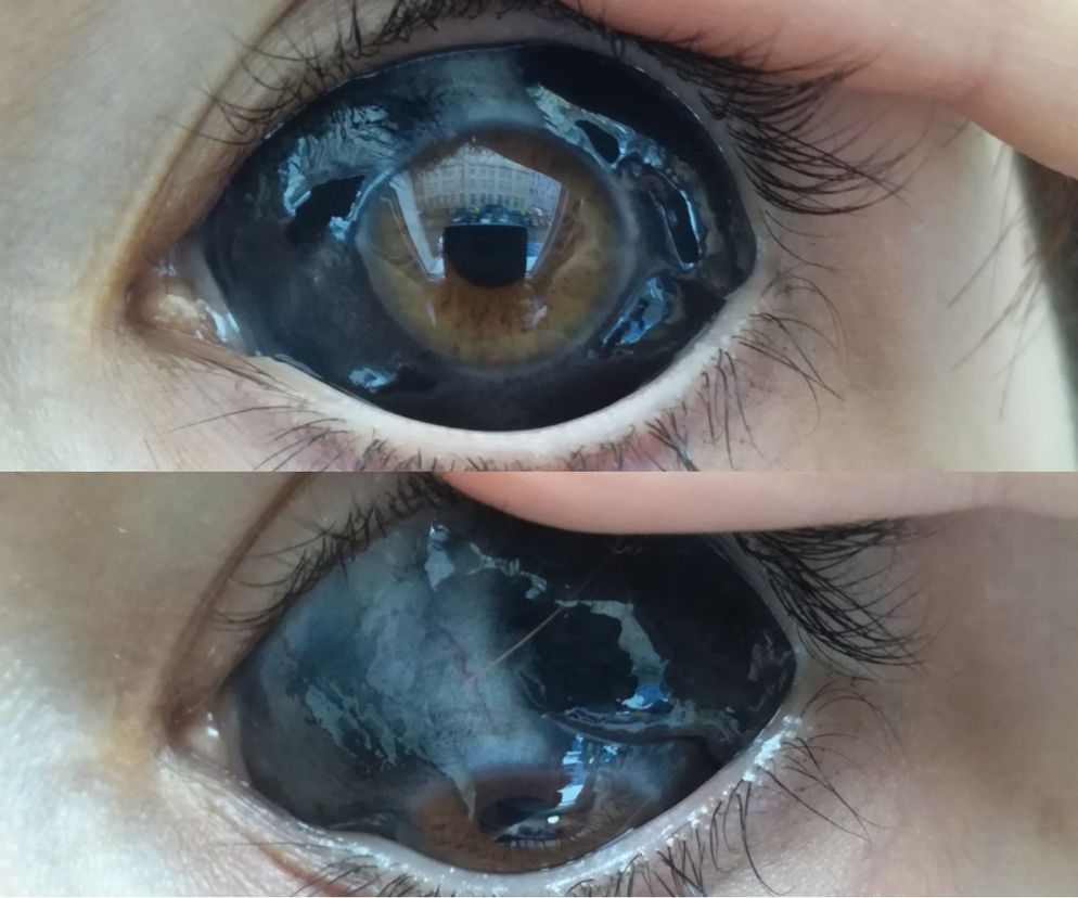 Tatuaż na oku: jak się go wykonuje i czy jest bezpieczny? Poznaj historię dziewczyny, która niemal straciła wzrok