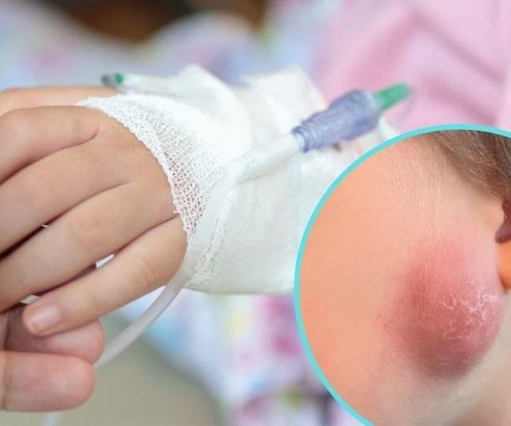 Dziecko miało guza na policzku. Diagnoza była szokiem dla rodziny i medyków