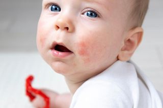 Jak wygląda wysypka alergiczna? Sprawdź, jak ją rozpoznać u dziecka i co może być jej przyczyną