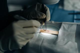 Poparzony górnik odzyskał włosy. Skomplikowany przeszczep przeprowadził światowej klasy chirurg.