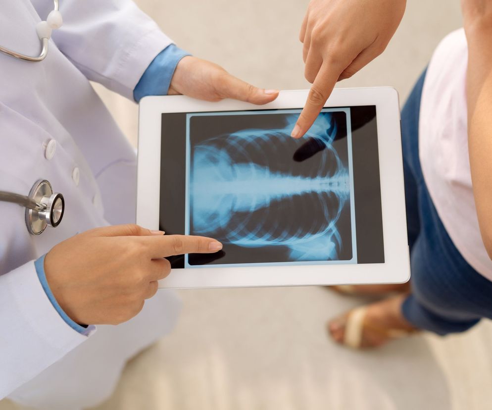 Zapalenie chrząstek żebrowych (zespół Tietzego) może objawiać się bólem podczas kaszlu czy kichania, a wywołane jest z reguły uderzeniem w klatkę piersiową lub zbyt intensywnym wysiłkiem fizycznym.