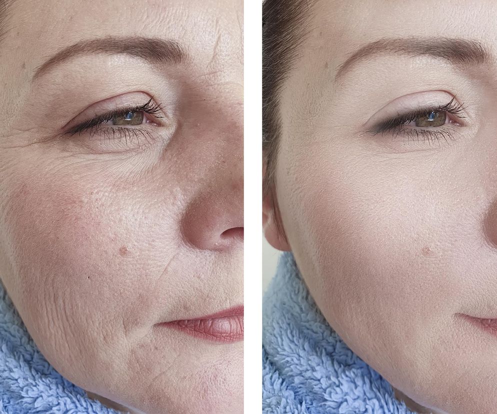 Zrób sobie botoks bez igieł. Tłuszczopot w aptece kosztuje tylko 9 zł a działa cuda