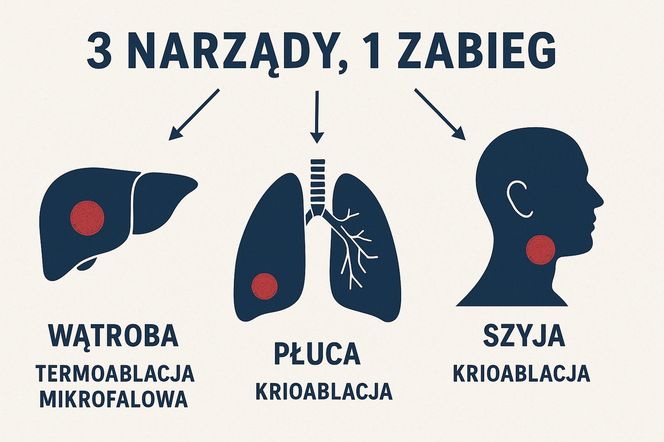 Jeden zabieg, zniszczone przerzuty w 3 narządach. 57-letnia pacjentka jutro idzie do domu!