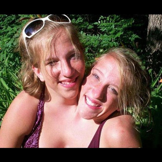 Siostry syjamskie urodziły dziecko?! Sensacyjne doniesienia