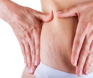 ROZSTĘPY - jak pozbyć się rozstępów z ud, pośladków, brzucha i piersi?