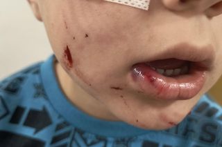 Pies pogryzł 4-letniego Frania. Chłopczyk w szpitalu, policja szuka właściciela