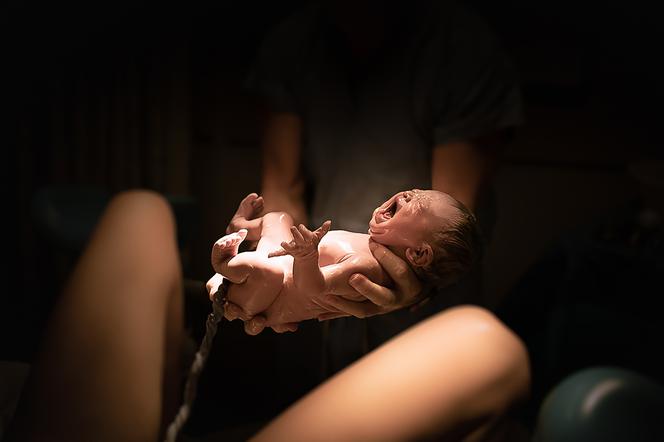 Dziecko z ogonem urodzone w Brazylii - jak to możliwe i jak często się zdarza? ZDJĘCIA