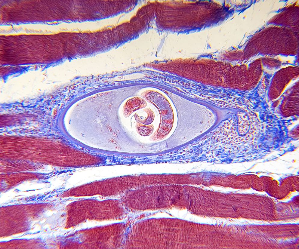 Włośnica (trychinoza, trichinelloza) to choroba pasożytnicza.