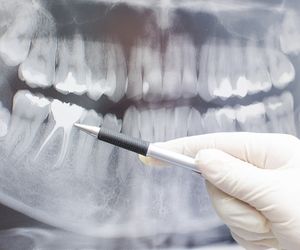 Rentgen (RTG) zębów - badanie radiologiczne zębów
