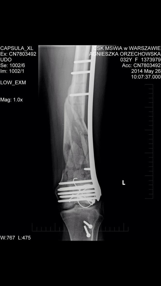 Wyrwą mi śruby z nogi