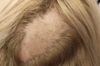Wyrwała włosy policjantce! Trwa zbiórka na leczenie zaatakowanej funkcjonariuszki 