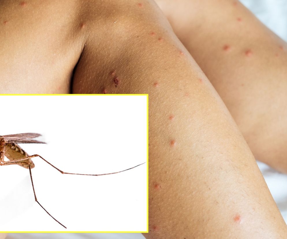 Mistrzowski sposób na komary! Ten naturalny składnik sprawi, że będą Cię omijać szerokim łukiem