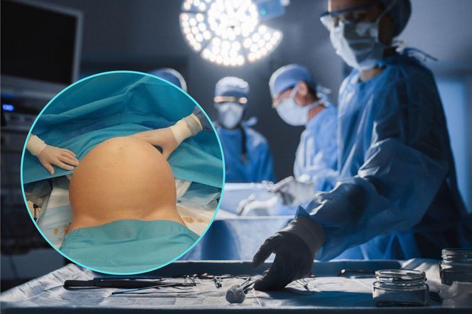 Usunęli półmetrowego guza z brzucha kobiety. Jeden z większych potworniaków