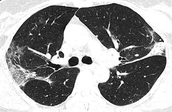 Tak wyglądają płuca 44-letniej ofiary koronawirusa