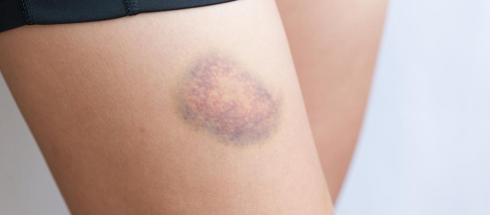 Niedobory witaminy K