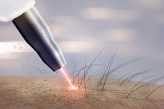 Depilator laserowy: jak działa, co wybrać? Wszystko o depilacji laserowej w domu