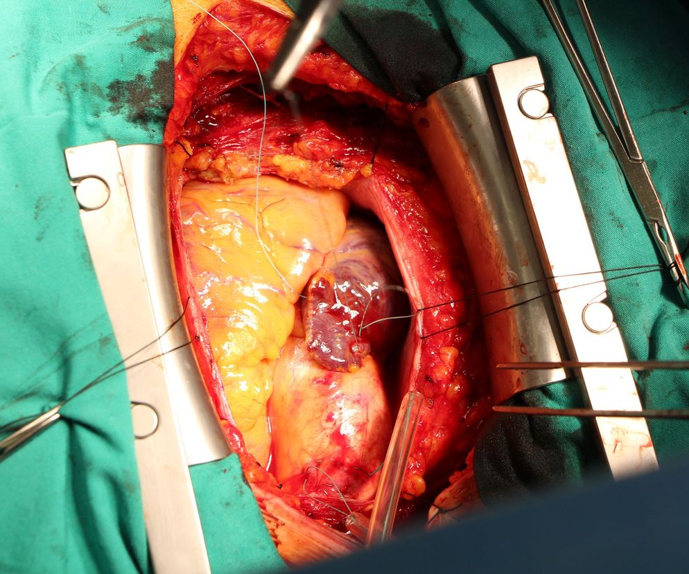 Sternotomia jest częścią wielu zabiegów kardio- i torakochirurgicznych, polega ona na przecięciu mostka.