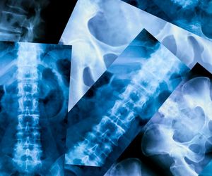 Kręgozmyk – przyczyny, objawy, leczenie