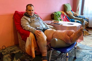 Nogę pana Pawła pokrywa 30-kilogramowa narośl, lekarze rozkładają ręce. Odetnę sobie tę nogę