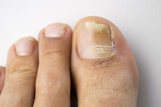 Jak wyglądają paznokcie zaatakowane przez grzybicę? Zobacz naszą galerię