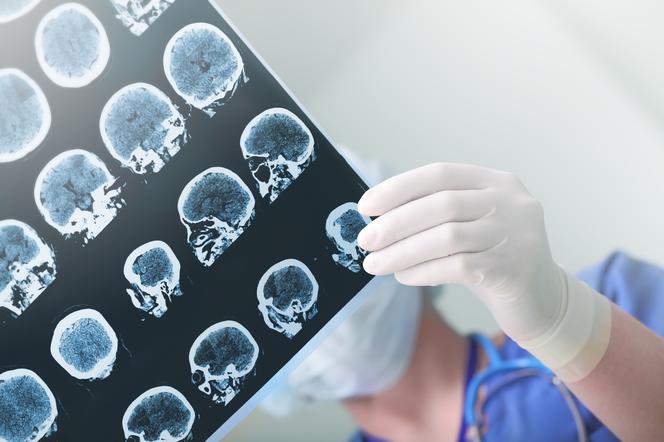 Naczyniaki mózgu - przyczyny, objawy i leczenie