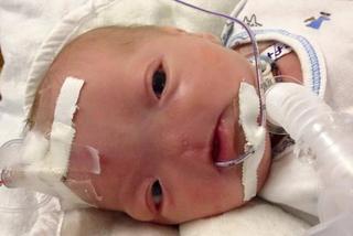Mały Timothy urodził się bez nosa