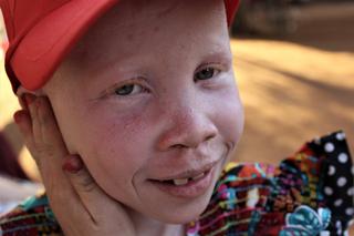 Bez pomocy nie mają szans na normalne życie. Fundacja z Krakowa zbiera pieniądze na wyposażenie domu dla albinosów w Afryce