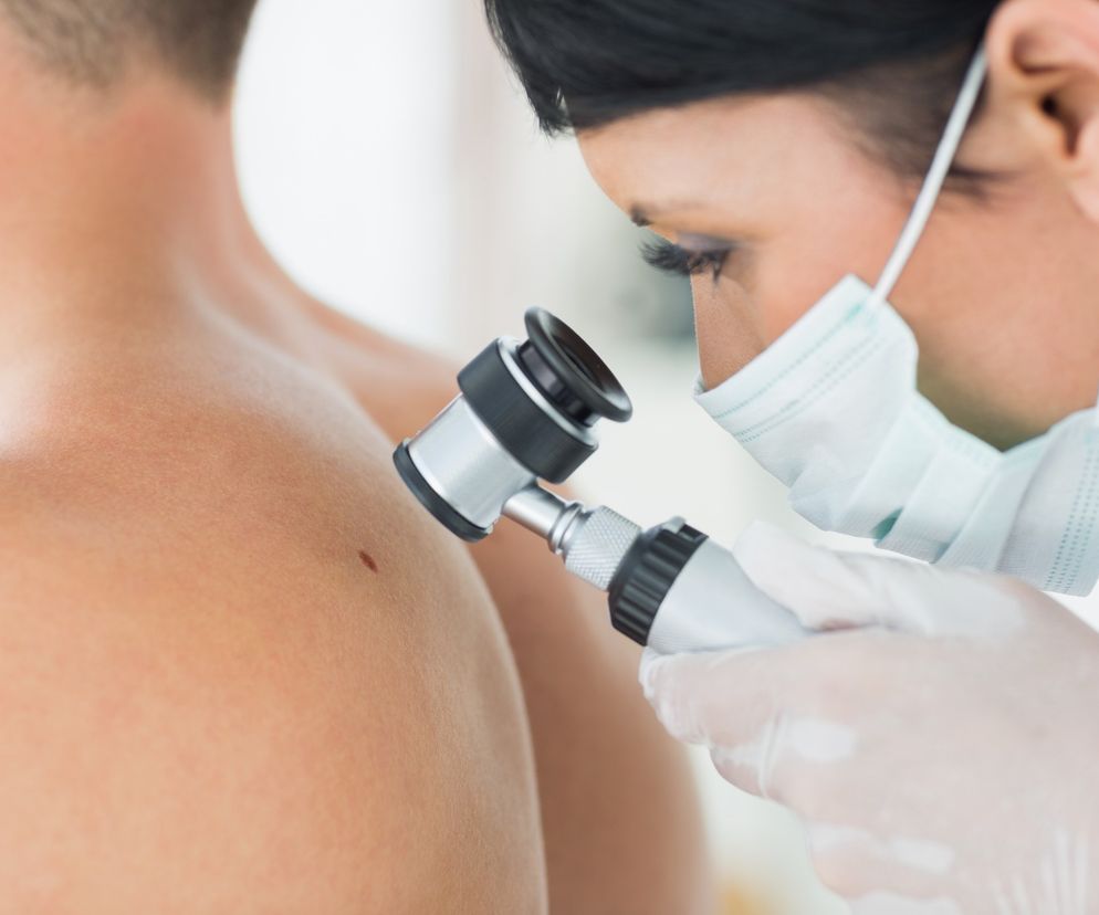 Dermatoskopia - badanie znamion dermatoskopem