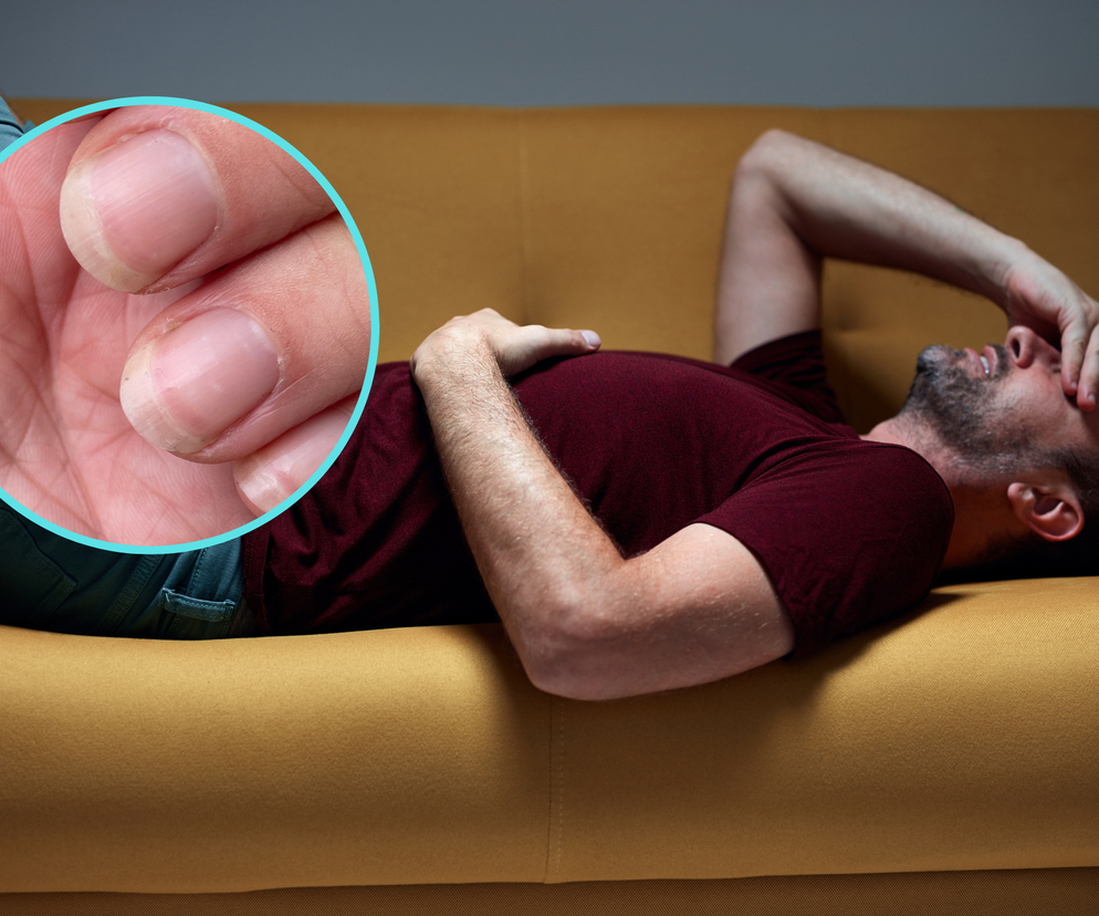 Hepatolodzy często widzą u pacjentów takie paznokcie. To objaw marskości wątroby