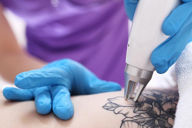 Tatuaż na bliźnie - czy to bezpieczne i skuteczne?