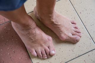 Boję się, że będę miała twarz giganta