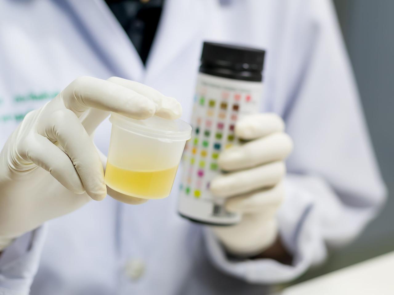 Krew w moczu. O czym świadczy krwiomocz u dziecka. Jakie wykonać badania?