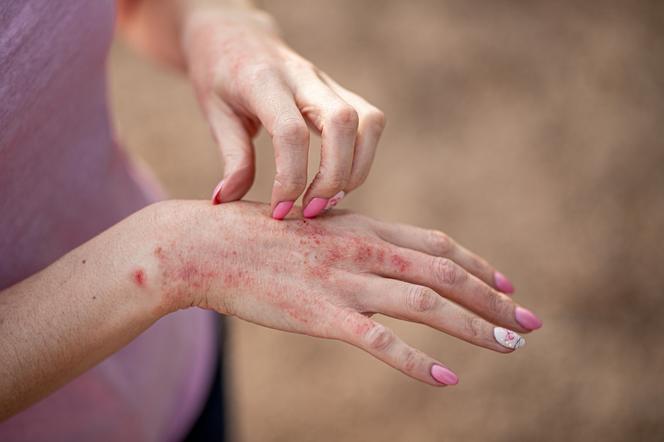 Zbliżenie na dłonie pokryte czerwonymi zmianami skórnymi 