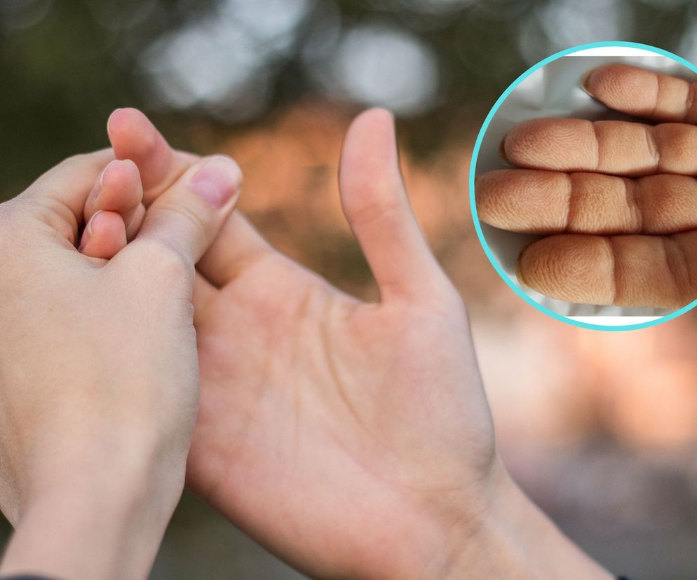 Palce jak flaczki sygnalizują groźne nowotwory. Na liście rak płuca